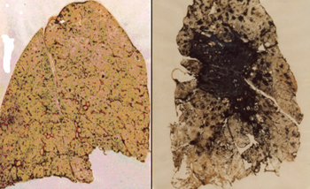 Living On Earth Black Lung Update New Study Confirms Worst Form Of Living On Earth Black Lung Update New Study Confirms Worst Form Of